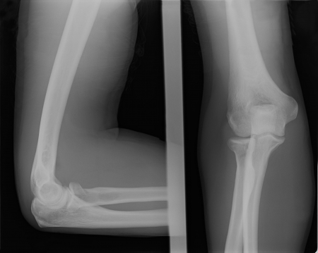 X-ray image of broken human elbowの写真素材