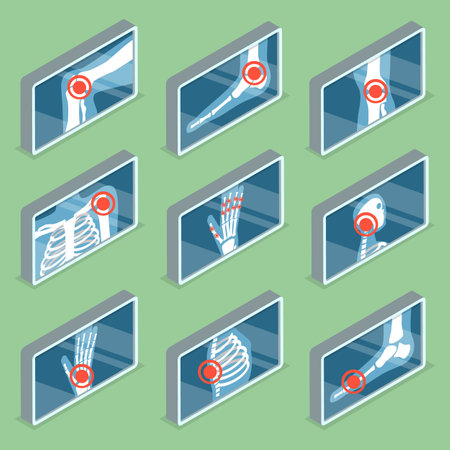 3D Isometric Flat Vector Set of Images of Human Joints , Arthritis and Osteoporosisのイラスト素材