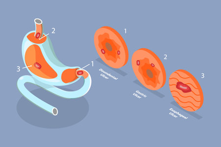 3D Isometric Flat Vector Conceptual Illustration of Peptic Ulcer Stomach Disease, Gastritis and Inflammationのイラスト素材