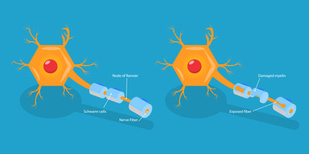 3D Isometric Flat Vector Conceptual Illustration of Multiple Sclerosis, Demyelinating Diseaseのイラスト素材