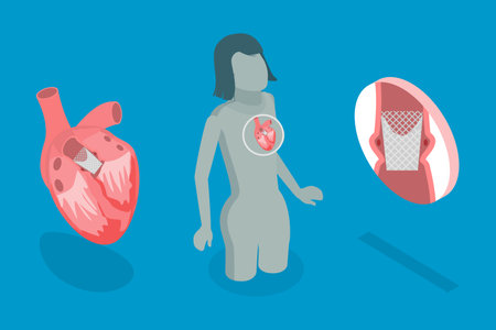 3D Isometric Flat Vector Conceptual Illustration of Transcutaneous Aortic Valve Replacement - TAVR, Minimally Invasive Surgeryのイラスト素材