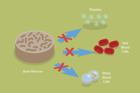 3D Isometric Flat Vector Conceptual Illustration of Aplastic Anemia, Blood Disorder Causing Low Blood Cell Productionのイラスト素材