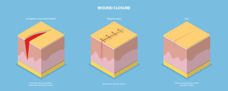 3D Isometric Flat Vector Conceptual Illustration of Wound Closure, Tissue Injury Healingのイラスト素材