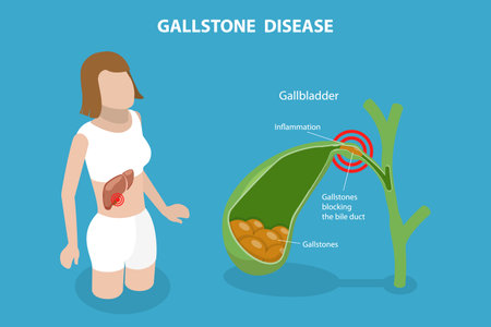 3D Isometric Flat Vector Conceptual Illustration of Gallstone Disease, Formations in the Gallbladderのイラスト素材