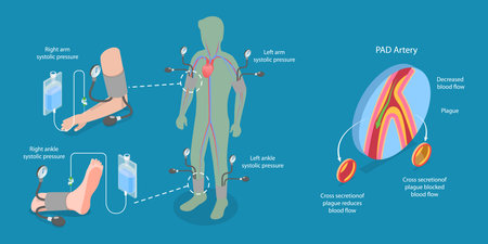 3D Isometric Flat Vector Illustration of ABI Test, Limb Ischemia Diagnosisのイラスト素材