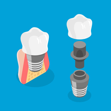 3D Isometric Flat Vector Illustration of Tooth implant, Dental Prosthesisのイラスト素材