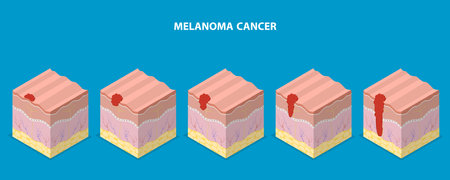 3D Isometric Flat Vector Illustration of Melanoma Cancer, Dermatology and Skin Healthのイラスト素材