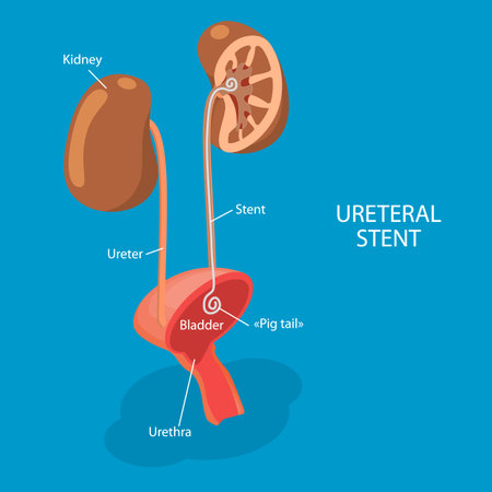 3D Isometric Flat Vector Illustration of Ureteral Stent, Treatment For Kidney Stonesのイラスト素材