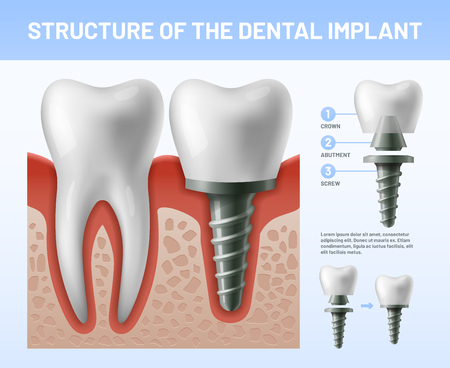 Dental teeth implant. Implantation procedure or tooth crown abutments. Health care or fractured dent implanted teeth. Crowns veneers prosthesis treatment dentistry vector illustrationのイラスト素材