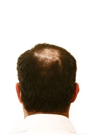 male head with hair loss symptomsの写真素材