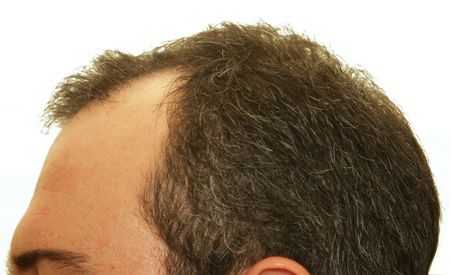 male head with hair loss symptomsの写真素材