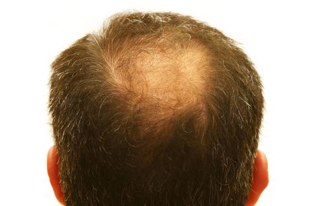 male head with hair loss symptomsの写真素材