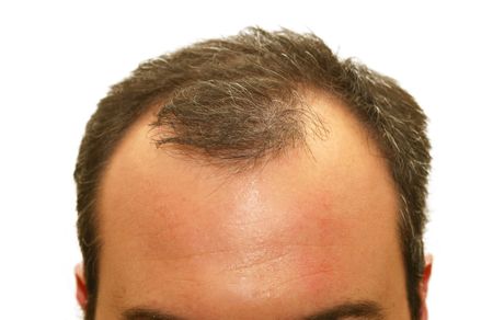 male head with hair loss symptomsの写真素材