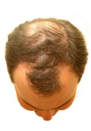 balding headの写真素材