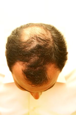 loosing hairの写真素材