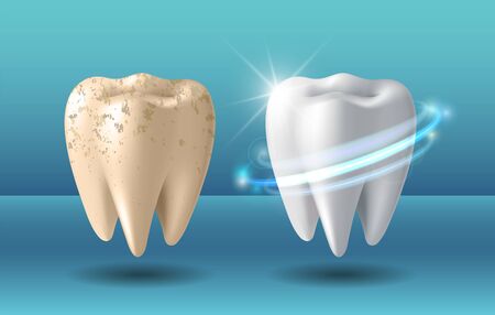 Teeth whitening 3d concept. Comparison of clean and dirty tooth before and after whitening treatment. Teeth whitening procedure, dental health and oral hygiene poster for dentistry designのイラスト素材