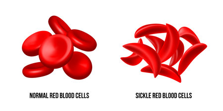 Sickle cell disease. The difference of Normal red blood cell and sickle cell.のイラスト素材