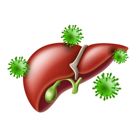 Hepatitis. Humans liver with viral infection viruses hepatitis.のイラスト素材