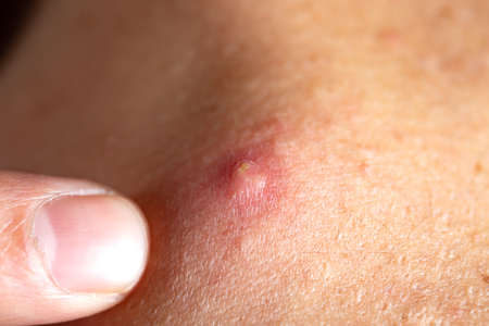 man skin problem on the shoulderの写真素材