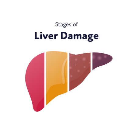 Liver damage infographic. Vector flat illustration. Anatomical human organ. Stages of cirrhosis disease from healthy to fatty and fibrosis on parts of liver. Design for health care, educationのイラスト素材