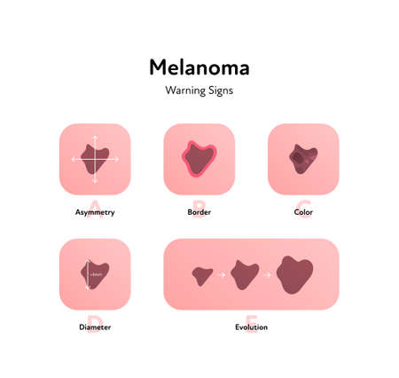 Melanoma cancer anatomical infographic poster. Vector flat medical illustration. Warning signs of tumor disease. Asymmetry, border, color, diameter. Design for healthcare, oncology, dermatology.のイラスト素材