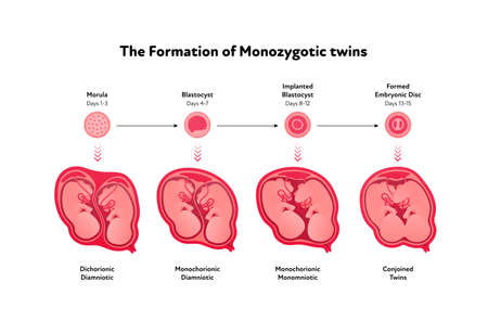 Embryo in womb medical diagram. Vector flat healthcare illustration. Formation of monozygotic twins. Design for health care, education.のイラスト素材
