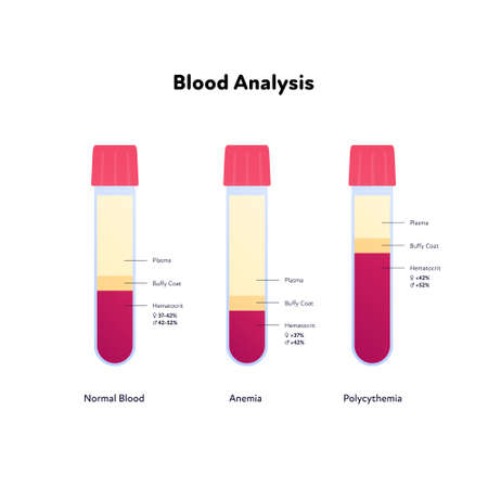 Blood analysis infographic. Vector flat healthcare illustration. Blood sample of normal, anemia and polycythemia. Design for pharmacy, health care.のイラスト素材