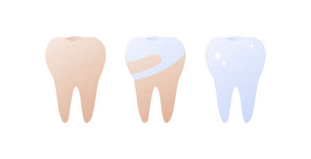 Tooth whitening, cleaning and stomatology concept. Vector flat healthcare illustration. Stages from yellow to clean white teeth. Design for dentistryのイラスト素材