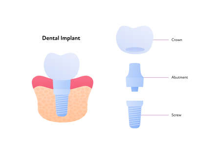 Tooth implant chart. Vector biomedical illustration. Cross section. Teeth prosthesis scheme isolated...