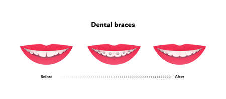Dental teeth braces before and after infographic. Vector flat healthcare illustration set. Smile mouth with tooth and brace isolated on white background. Design for health care poster.のイラスト素材
