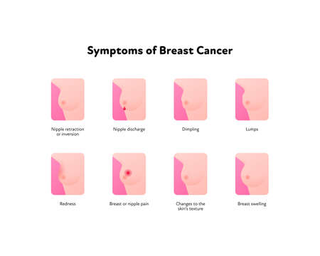 Breast cancer symptoms infographic. Vector flat healthcare illustration. Set of icon symbol with symptom and text isolated on white background. Design for awarness month, posterのイラスト素材