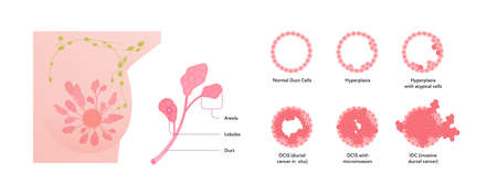 Human breast cancer anatomy diagram. Vector flat medical illustration. Front view. Stages disease and tumor cells isolated on white background.のイラスト素材