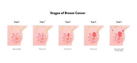 Human breast cancer anatomy diagram. Vector flat medical illustration. Front view. Stages of tumor disease isolated on white background. Design for healthcare, science, education, oncology.のイラスト素材