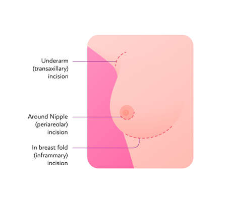 Female breast surgery infographic chart. Vector flat medical illustration. Underarm transaxillary, periareolar, inframmary incision types. Design for beauty healthcare industry.のイラスト素材