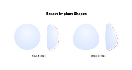Female breast surgery infographic chart. Vector flat medical illustration. Set of blue round and teardrop implant type on white background.のイラスト素材