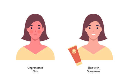 Summer skin care and sunscreen protection concept. Vector flat people illustration. Compare of woman with unprotected skin tan and protected with cream. Design for beauty industry and healthcareのイラスト素材