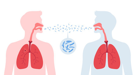 Tuberculosis disease concept. Vector flat healthcare illustration. People silhouette with lung infection other by tb isolated on white background. Design element for health care, education, pulmonologyのイラスト素材