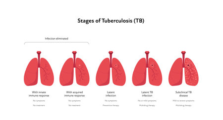 Tuberculosis disease concept. Vector flat healthcare illustration. Stages of tb infected lung isolated on white background. Design element for health care, education, pulmonology posterのイラスト素材
