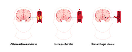 Brain neural disease for healthcare infographic. Vector flat illustration. Atherosclerosis, ischemic, hemorrhagic strokes. Brain front view with vessel, blood clot. Design for health care, educationのイラスト素材