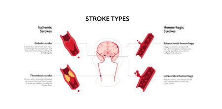 Brain neural disease for healthcare infographic. Vector flat illustration. Embolic, thrombotic, ischemic, hemorrhagic, subarachnoid, intracerebral stroke. Design for health care, educationのイラスト素材