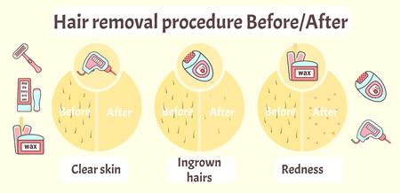 Flat vector hair removal aftereffects infographics. Comparison of hair removal before procedure and after effects view - clear skin, redness and ingrown hairsのイラスト素材
