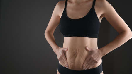 Woman showing stretch mark loose lower abdomen skin. Fat belly after pregnancy baby birth.Tummy tuck, flabby skin on a fat belly, plastic surgery conceptの写真素材