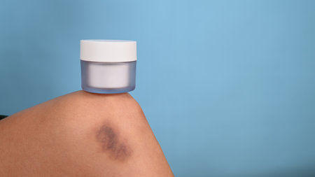 Bruise on womans leg skin isolated on blue background. Bruise concealing cream in white jar....