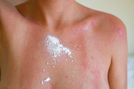 Protective aerosol is applied to sunburn on womans skin. Woman with sunburn on her chest.の写真素材