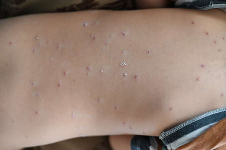 Young boy with varicella zoster virus. Closeup of cute sad boy with chickenpox bubble rash on child.の写真素材