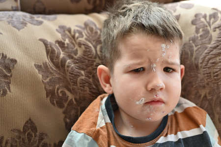Portrait of little boy with varicella zoster virus. Closeup of cute sad boy with chickenpox bubble rash on child.の写真素材