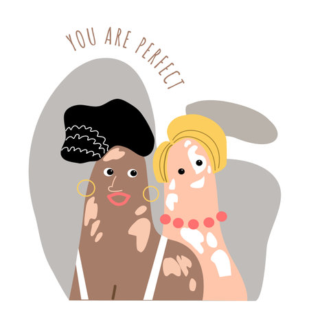 Cartoon vitiligo women portrait vector illustration .World vitiligo day June 25.Beautiful face of an African American woman.Diversity tolerance concept.のイラスト素材