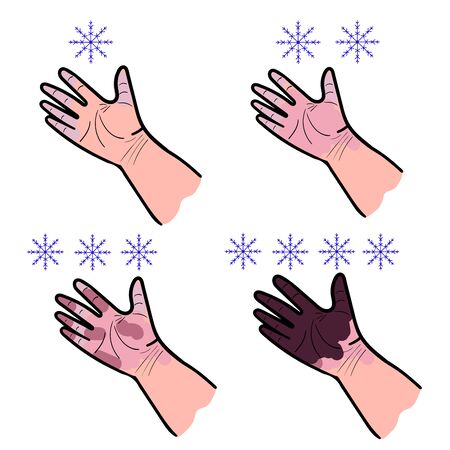 set of four hand drawings on a white background stage of frostbite vector illustrationのイラスト素材