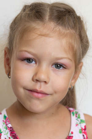 Portrait of caucasian little girl of five years old with swelling eyes because of allergy,...