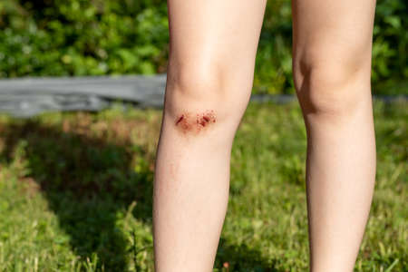 child's legs with injured knees close up, concept of child safety during summer games. High quality...
